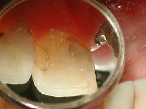 Вид переднего верхнего зуба изнутри(съемка в стоматологическое зеркало)