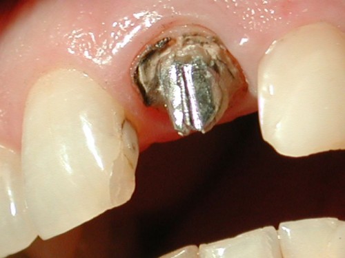 Удалили старую коронку, видим старую вкладку