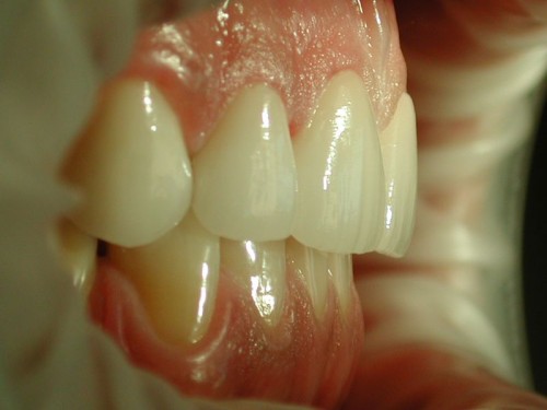 Вид красивых керамических коронок справа