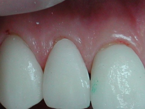 Макро краевого прилегания керамических коронок к зубам