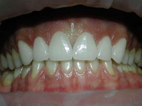 Красивые керамические коронки - вид спереди